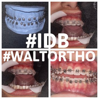 Faster Orthodontic Treatment Part 2 – Indirect Bonding