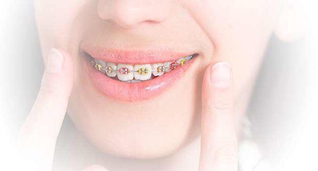 Do You Need Braces? Here Are Some Important Tips When Looking for an Orthodontist.