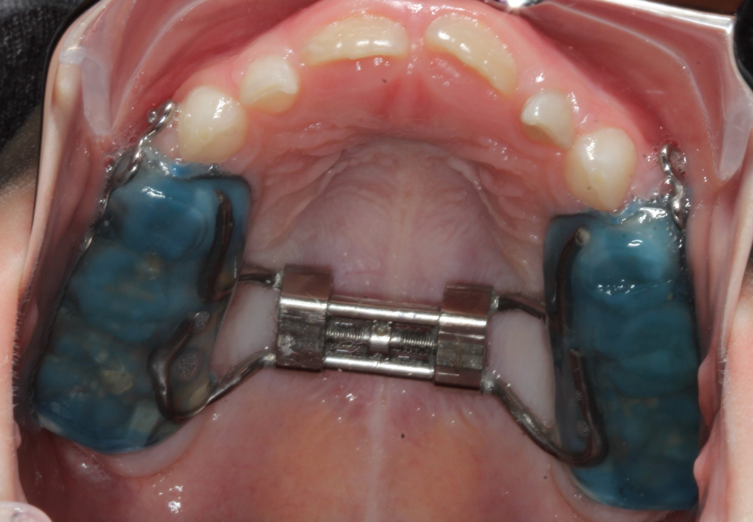 What is Palate Expander?