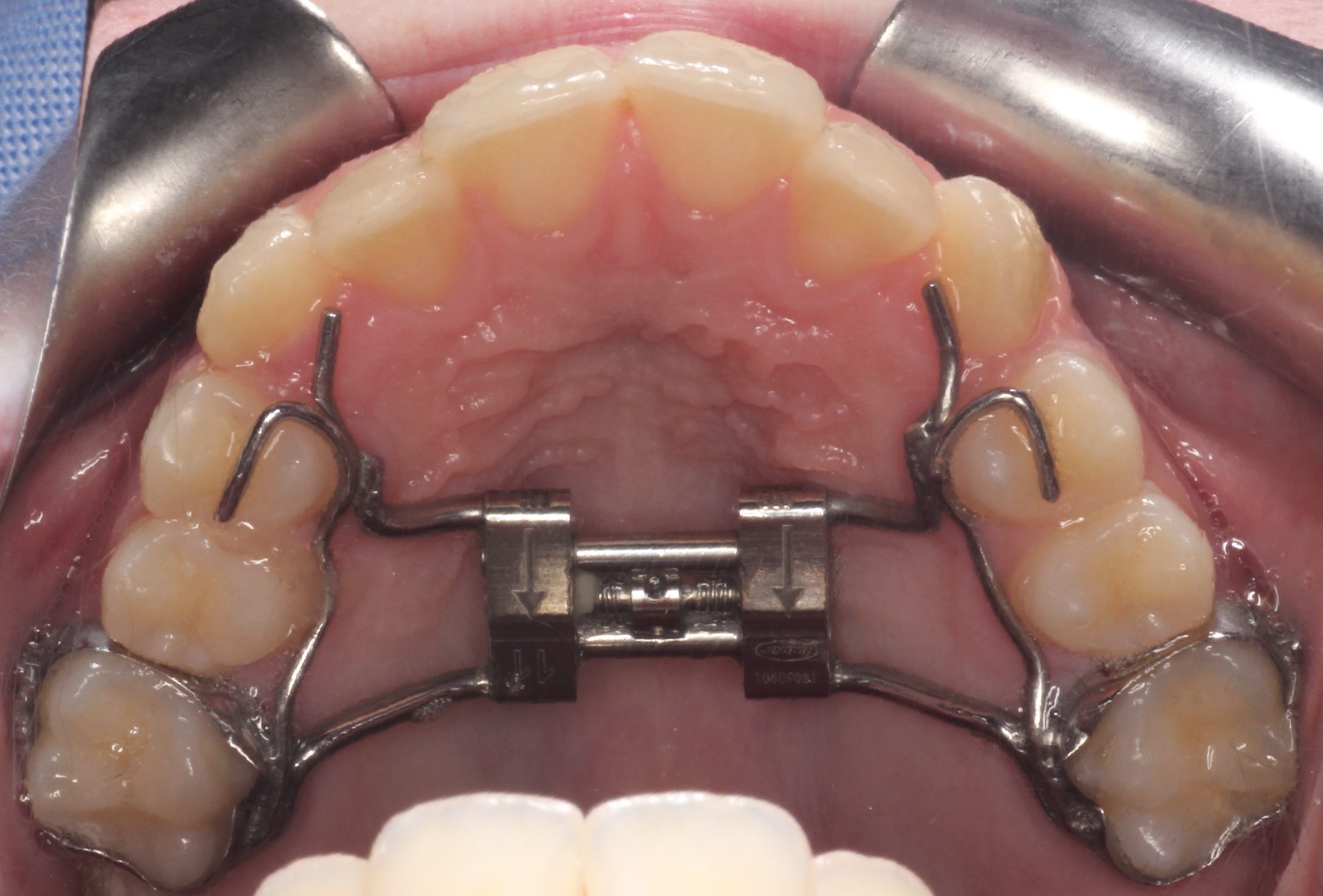 https://www.waltortho.com/wp-content/uploads/2020/04/hyrax-palatal-expander.jpg