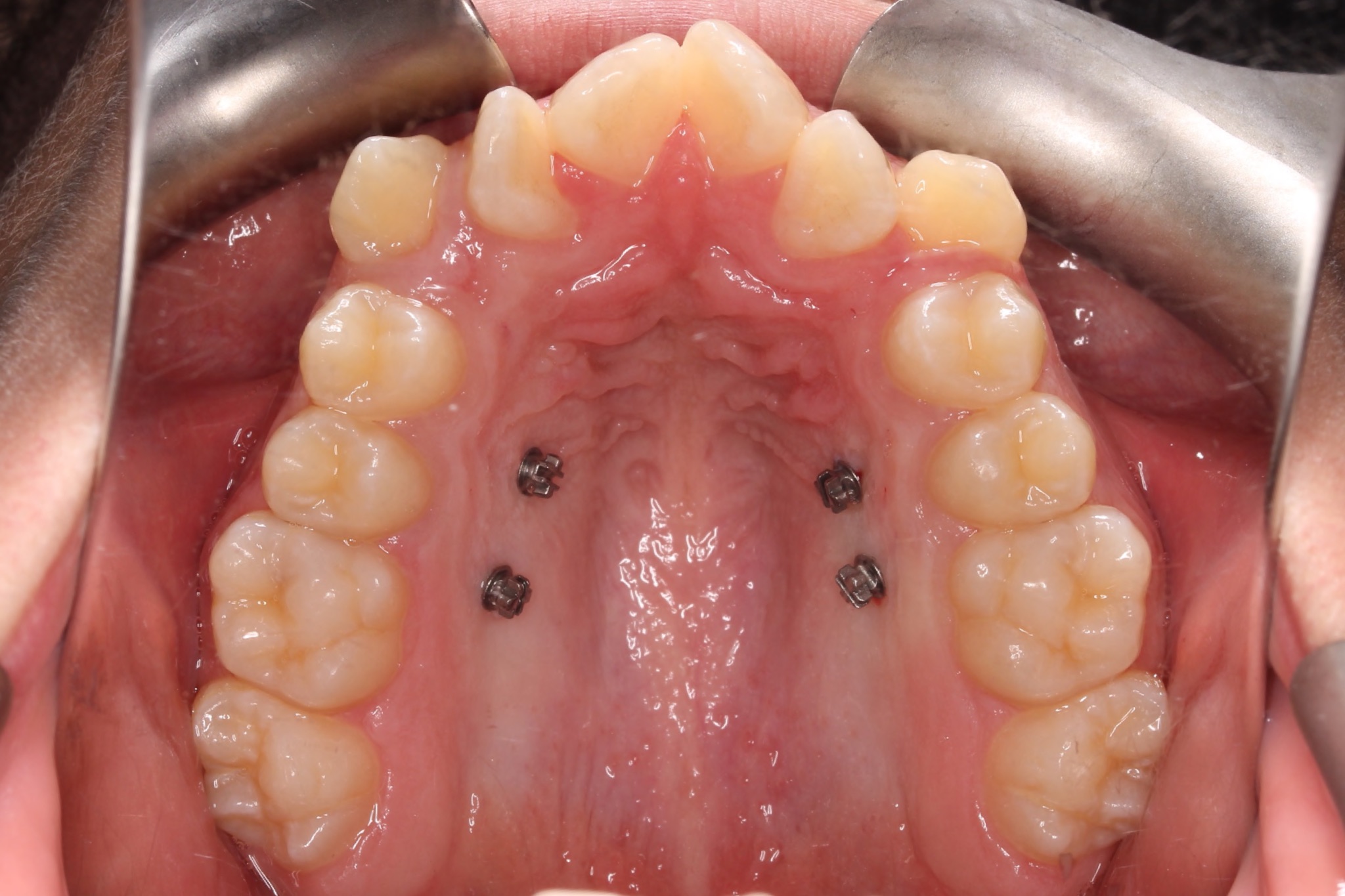 Palatal Expanders: Why, How, and When - Orthodontist Vaughan