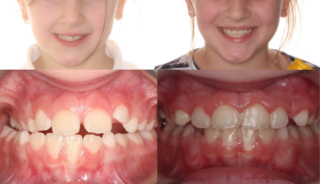 Palatal Expanders: Why, How, and When - Walt Orthodontics
